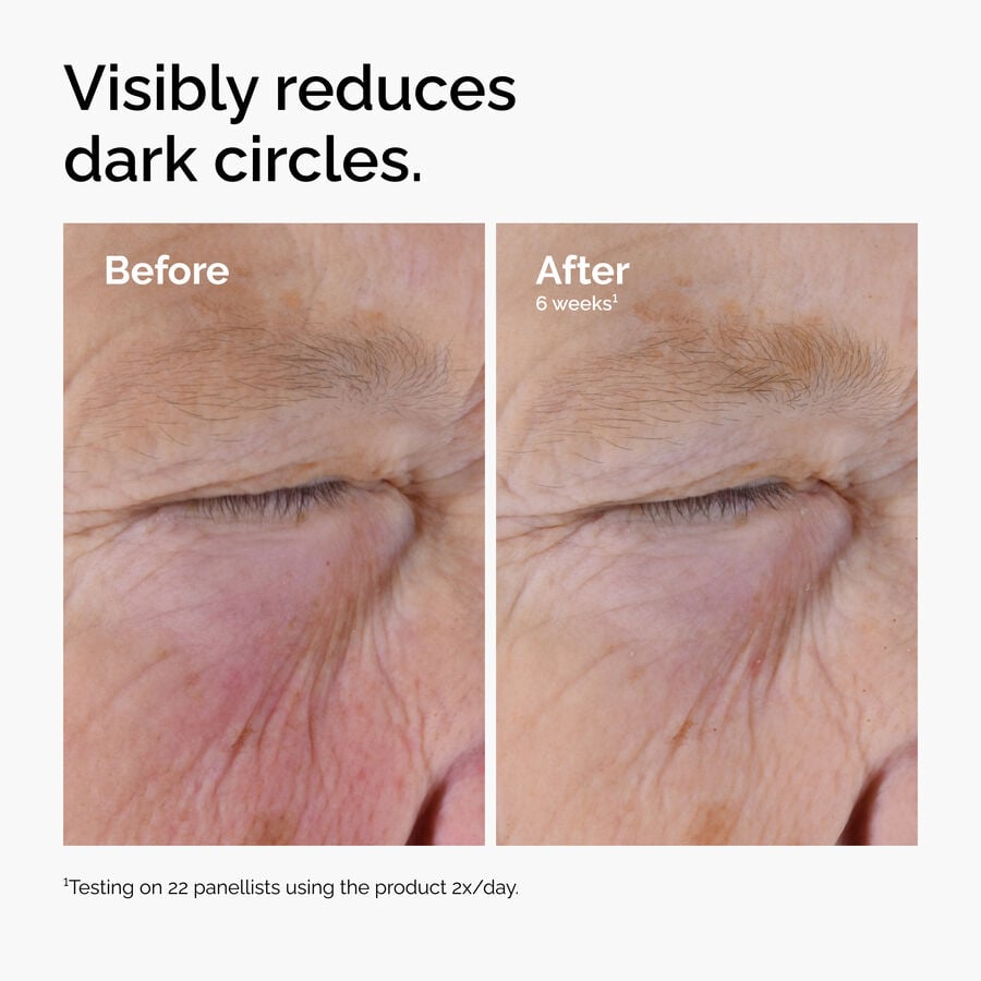 caffeine-solution-5-egcg-eye-serum-s4 ord-caffeine-solution-egcg-dark-circles-before-after.jpg