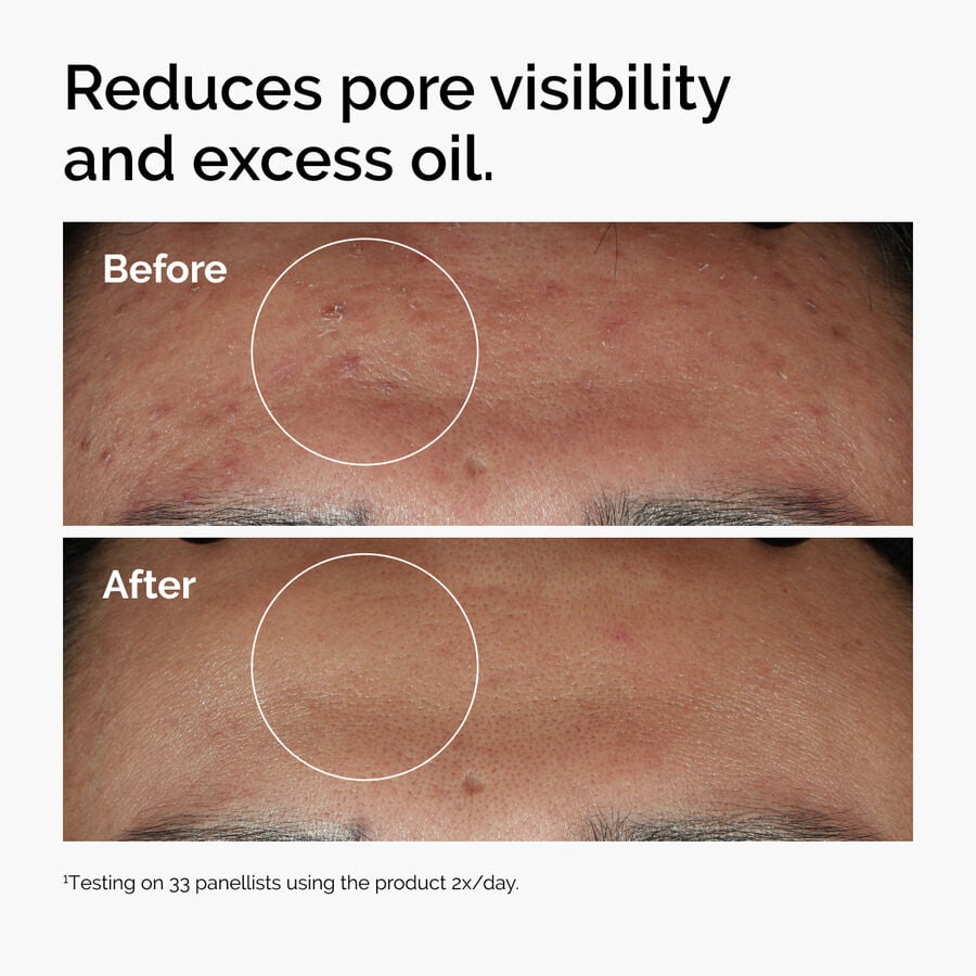 niacinamide-10-zinc-1-m7 ord-niacinamide-zinc-blemish-serum-before-after-pores.jpg