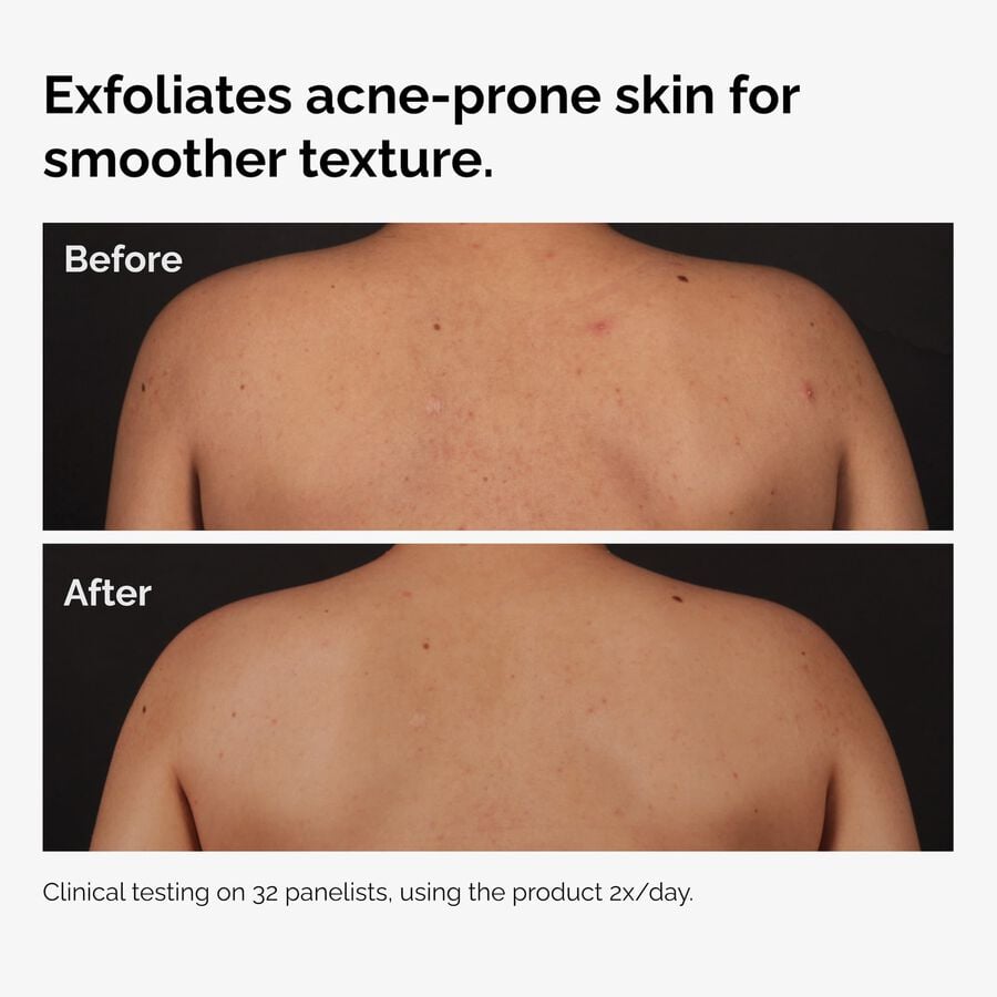 salicylic-acid-0-5-body-serum-v1 ord-salicylic-acid-body-serum-before-after-graphic-NA.jpg