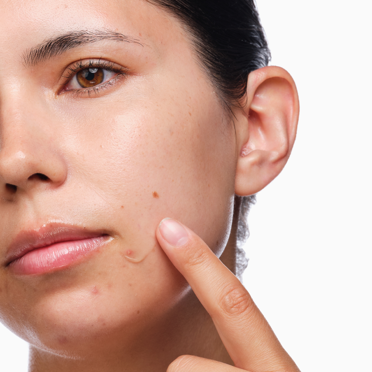 the-acne-set-c0 rdn-the-acne-set-application.png